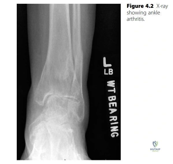 Illustration of ankle structured oral - Dr. Mohammed Hutaif