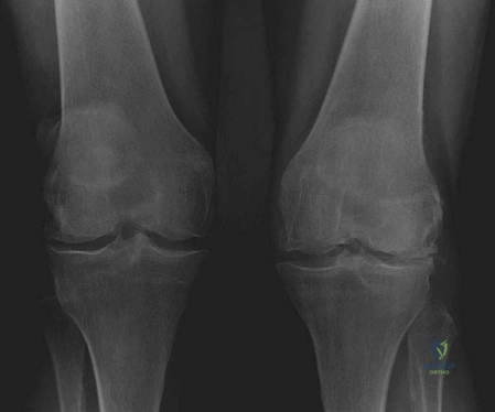 صورة شعاعية أمامية خلفية للركبتين تظهر تضيقًا في المسافة المفصلية وتشوهًا روحاء