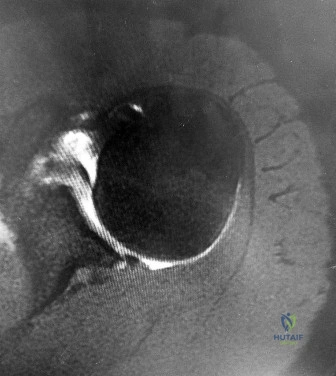 ABOS Part I & AAOS OITE Orthopaedic Review: Patellofemoral Instability & Hallux Rigidus MCQs | Part 22225