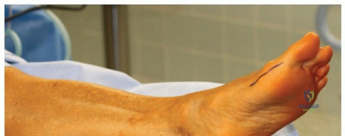 ABOS Part I Comprehensive Orthopaedic Review: Ankle, Knee PJI, Hip Arthroplasty | Part 22307