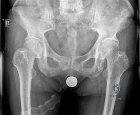 Illustration of pagets disease candidate - Dr. Mohammed Hutaif