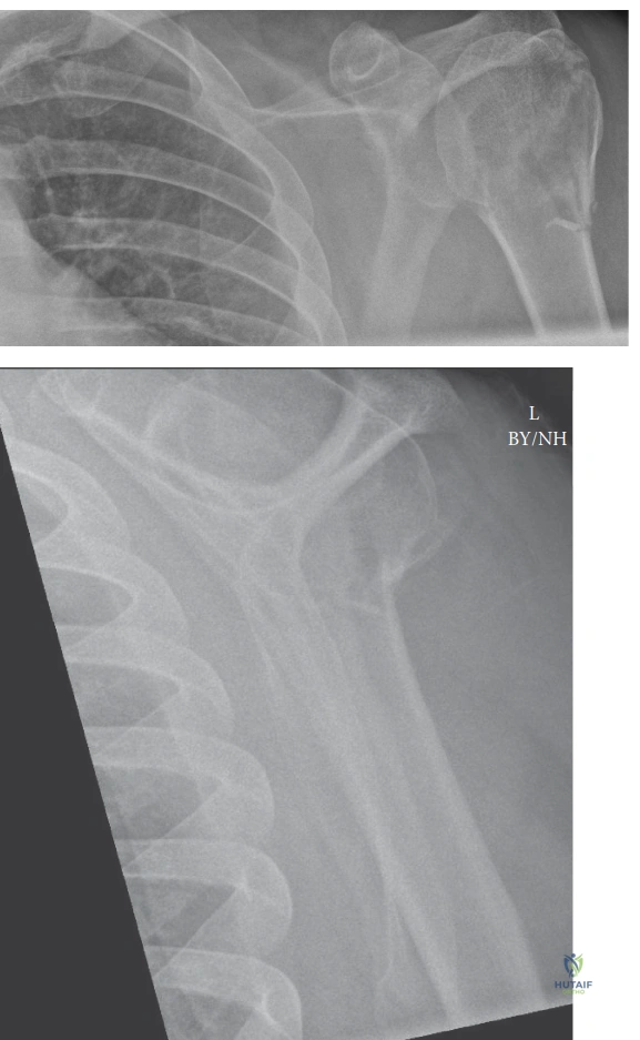 Illustration of humerus fracture proximal - Dr. Mohammed Hutaif