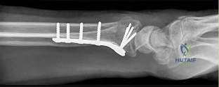 ABOS Part I Orthopedic Surgery Board Review: Shoulder, Humerus, & Fracture Fixation Principles | Part 21540