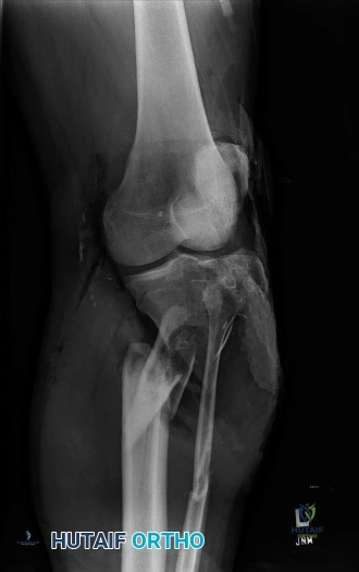 إدارة كسور الساق المفتوحة المعقدة مع إصابات الأوعية الدموية والأعصاب: دليل شامل