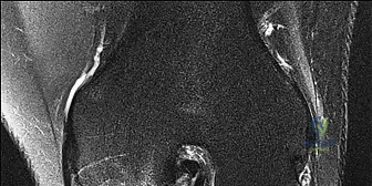 ABOS Part I Orthopaedic Surgery Review: Deformity Correction, Osteotomies & Fixation Principles | Part 21916