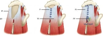تمزق الكفة المدورة على شكل حرف U وإصلاحه باستخدام التقارب الهامشي. SS: العضلة فوق الشوكة، IS: العضلة تحت الشوكة.