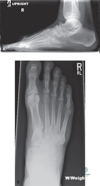 إبهام القدم المتصلب (Hallux Rigidus): دليلك الشامل من الأسباب للتعافي مع الأستاذ الدكتور محمد هطيف