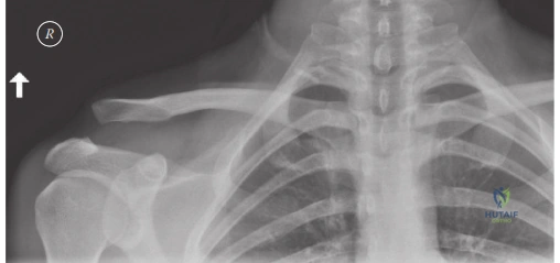صورة توضيحية لـ إصابات مفصل الترقوة الأخرمي (AC Joint): دليلك الشامل للتشخيص والعلاج في صنعاء مع الأستاذ الدكتور محمد هطيف