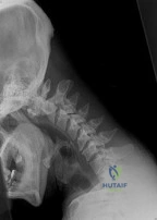 ABOS Part I Orthopaedic Surgery Board Review: Sagittal Plane Deformity & Paley's Method | Part 22019
