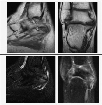 Pediatric Ankle Pain: Diagnosis Involves the Subtalar Joint