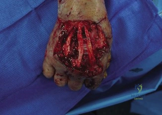 ABOS Part I & AAOS OITE Orthopaedic Surgery Review: Hand, Upper Extremity, Fractures & Pediatric Elbow Trauma | Part 21559