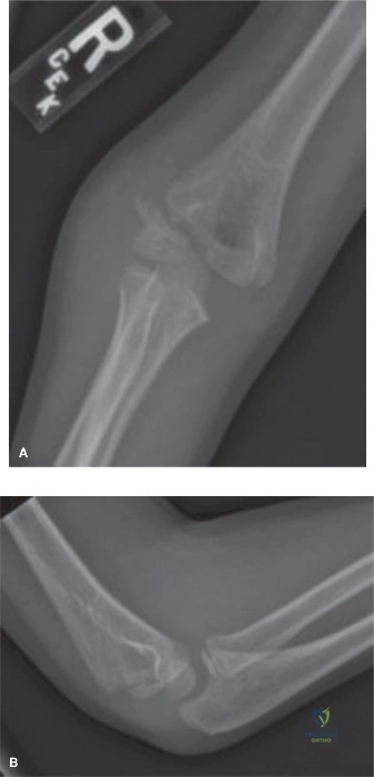 Intraoperative image showing a reduced pediatric lateral condyle fracture