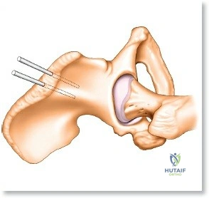 Orthopaedic Surgery Board Review: Hand Infections, Gout, & Metacarpal Fractures MCQs | Part 22161