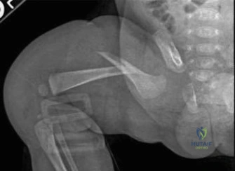 Pediatric Orthopaedics, Hand Surgery, Spine Trauma Review for ABOS Part I | Part 22303