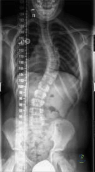 PA full spine X-ray showing scoliosis