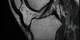 صورة توضيحية لـ تمزق الرباط الصليبي الأمامي وإصابات الركبة المعقدة: دليل شامل من الأستاذ الدكتور محمد هطيف صنعاء
