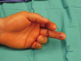 صورة توضيحية لـ إصلاح الأوتار القابضة في اليد: دليل شامل للتعافي من إصابات اليد مع الأستاذ الدكتور محمد هطيف