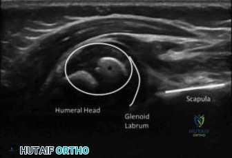 خلع الورك الولادي Hip Dysplasia