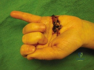 قطع الأوتار القابضة في الإصبع (FDS/FDP) بالمنطقة الثانية: دليل شامل للمرضى مع الأستاذ الدكتور محمد هطيف