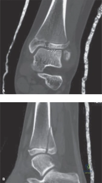 Illustration of closure of the distal - Dr. Mohammed Hutaif