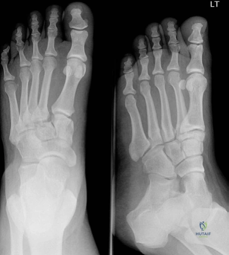 Illustration of ap and oblique - Dr. Mohammed Hutaif