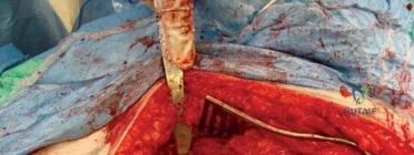 صورة طبية: استبدال مفصل الورك الكلي الناجح في خلل التنسج النمائي للورك: دليل شامل من الأستاذ الدكتور محمد هطيف