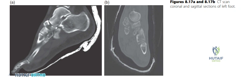 صورة مقطعية (CT Scan) تظهر مقاطع إكليلية وساجيتالية لكسر جسم العظم الزورقي