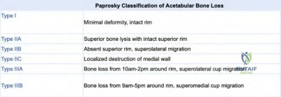 Orthopedic Oncology Board Review: Chondrosarcoma, Osteosarcoma, NOF | ABOS Part I & OITE Exam Prep | Part 21594