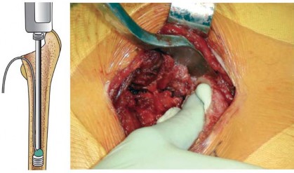 Illustration 25 for Mastering Cementing Technique Femur: A Step-by-Step Guide