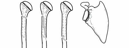 Illustration 10 for Periprosthetic Fractures: Causes, Risks, & Effective Treatment