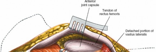 Illustration 109 for Unlocking Every Aspect of the Hip's Surgical Approaches