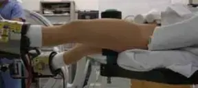 صورة توضيحية لـ كسور عظم الفخذ: دليل المريض الشامل لعلاج الشروخ تحت العضلات واستعادة الحركة