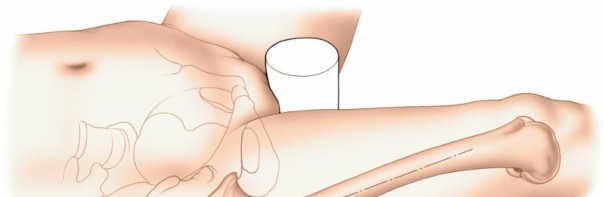 Illustration 72 for Optimal Femoral Approaches: Mastering the Lateral Intermuscular Septum