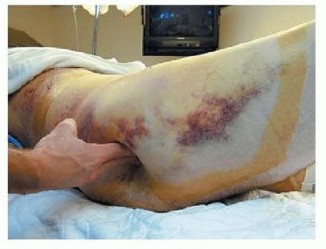 Illustration 8 for Achieve Stable Fixation of the Symphysis: Open Reduction