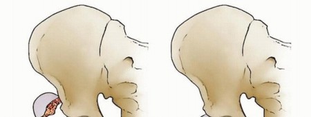 Managing Hip Fractures in Patients Younger Than Years: Key Info