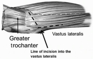 Illustration 5 for Hip Arthrodesis: The Definitive Hip Solution for Active Young Adults