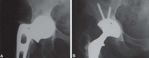 Illustration 35 for Total Hip Replacement for Protrusio: Restore Your Hip Function