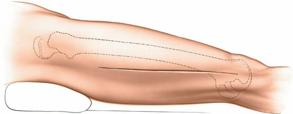 Illustration 15 for Optimal Femoral Approaches: Mastering the Lateral Intermuscular Septum