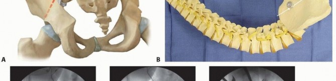 Illustration 13 for Duchenne Muscular Dystrophy: Is Spinal Fusion the Answer?