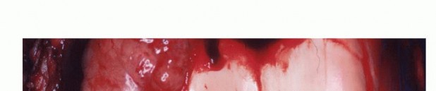 Illustration 12 for Precision Biopsy of Musculoskeletal Tumors for Accurate Diagnosis