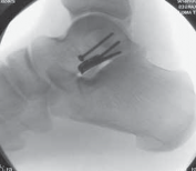 Illustration 38 for Talar Neck Fracture Treatment: Optimizing Recovery with ORIF