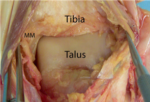 Illustration 2 for First Metatarsal Surgery: Expert Solutions for Foot & Ankle Pain