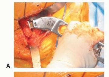 Illustration 34 for Hemiarthroplasty of the Hip: Indications & Types Explained