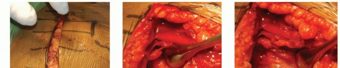 Illustration 16 for Optimizing Fixation of Proximal Humerus Fractures: A Guide