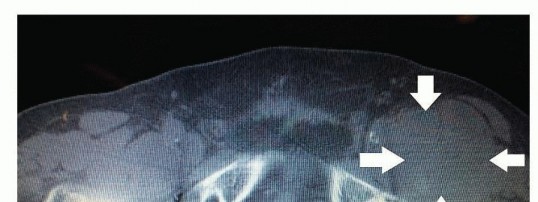 Illustration 5 for Which Bearing Surface Options Are Best for Your Total Hip?