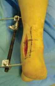 Illustration 10 for Talar Neck Fracture Treatment: Optimizing Recovery with ORIF