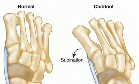 Why Anterior Tibialis Muscle Transfer Fixes Clubfoot