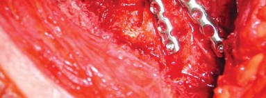 Illustration 21 for Management of Periprosthetic Fractures: An Expert Surgical Guide