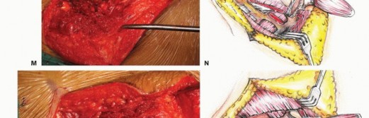 Illustration 39 for Sacral Tumor Surgery: Safeguarding Bowel & Bladder Control