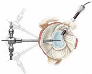 Illustration 22 for Capsular Releases for Loss of Motion: Restore Your Shoulder